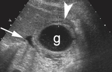 posterior acoustic shadowing at gallbladder neck Gallbladder distention Gallbladder wall thickening