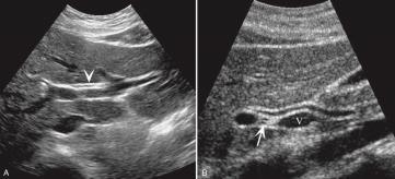 Rumack, Diagnostic ultrasound CBD, CHD, Right hepatic duct and left hepatic duct Lying anterior to the PVs