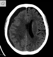 An isodense, extracerebral, homogeneous