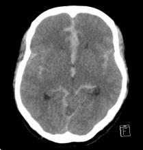 SUBARCHNOID HEMORRHAGE Serpentine or linear area of high