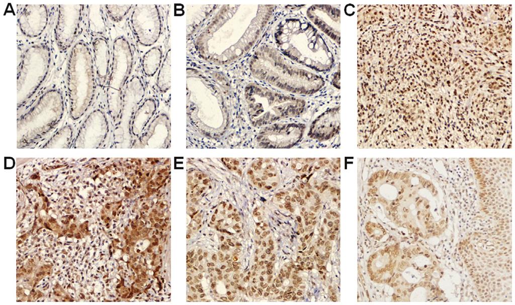 ONCOLOGY LETTERS 5 Figure 3. Immunohistochemistry stining of BANF1 in gstric cncer. (A) Norml gstric tissues. (B) Atypicl hyperplsi tissues. (C) Gstrointestinl stroml tumor tissues.