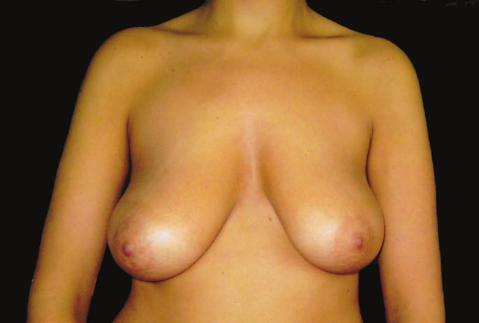 Table 6: Over all mean tissue resection from each side in group C, as well as respective mean tissue resection from each breast when breast were larger on either right (C1) or left side (C2) Average