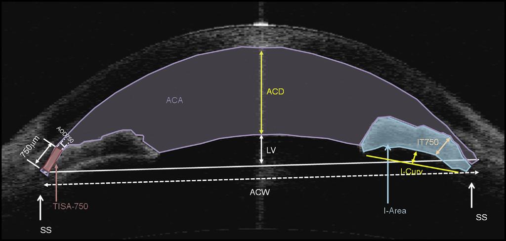 Sng et al Anterior Segment Imaging During APAC Figure 1. Measurement of anterior segment parameters on anterior segment optical coherence tomography images using the Anterior Segment Analysis Program.
