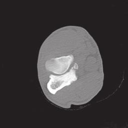 CT gives excellent detail of the shape (congruency) of the joint and enables detection of small bony fragments.