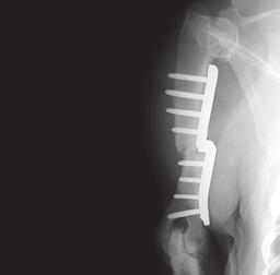surgery can be slow, the majority of dogs improve and have less elbow pain. There are possible complications, for example, breakage of the plate or screws.