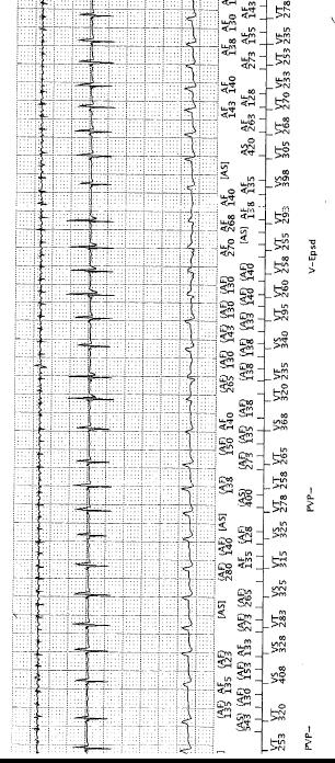 Inappropriate ICD Therapy Atrial