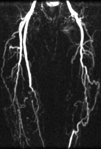 as well Aorta, RAS except proximal (maybe) peripheral for suspected artery