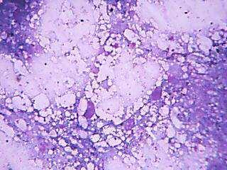 EPITHELOID CELLS GRANULOMA GELATINOUS TRANSFORMATION OF BM DISCUSSION :Bone marrow examination is very useful in the evaluation of hemato-oncological disorders.