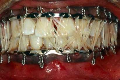 Next, use 24-gauge stainless steel circumdental wires to secure the arch bar to both arches. Place the patient into his or her preinjury occlusion.