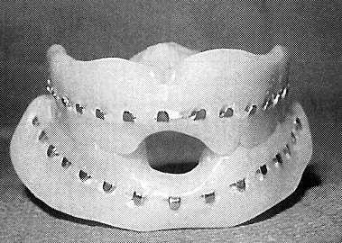 B- Closed Reduction of Edentulous Patients If dentures are available, they can be secured with circummandibular wires, circumzygomatic wires, or palatal screws.