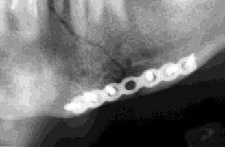 follicular cyst Teeth that prevent reduction of fractures should be removed.