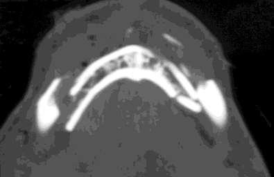 Number of fractures per mandible In patients with mandible fractures, 53% of patients had unilateral fractures, 37% of the patients had 2 fractures, and 9% had 3 or more fractures Fracture types : 1-