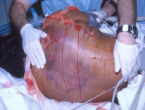 tissue dies The bacteria also enter the bloodstream and cause severe systemic illness called sepsis The result of skin popping - Multiple injection site abscesses 55 56 Indications of Necrotizing