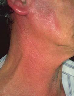 especially if the person has a high fever and appears ill from the infection Describe the features that make this cellulitis 19 20 Necrotizing Cellulitis Limited to skin and SQ, polymicrobial C.