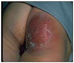 Abscess Abscess Large abscess Possibly up to a cup of pus when opened Crinkling of the skin suggests the swelling is going down Large abscess about to be incised (cut open) and drained of pus.