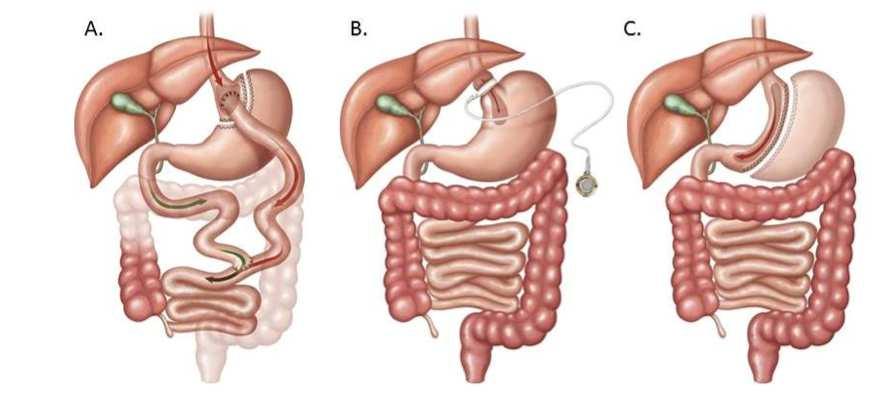 38 APPENDIX Roux-en-Y gastric bypass (RYGB), adjustable gastric banding (GB), and the sleeve gastrectomy (SG) (Figure 6). In RYGB, a small gastric pouch is constructed by stapling the stomach.