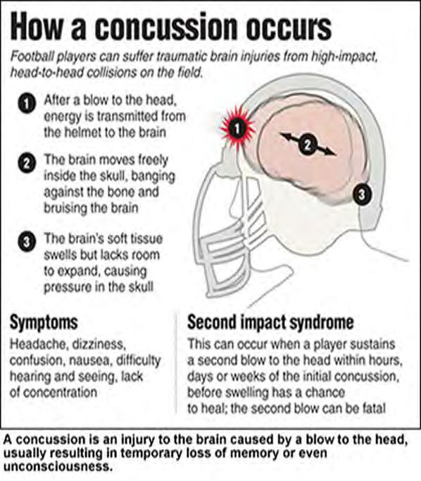 How a Concussion Occurs Concussion caused by transmitted impulsive forces to the brain
