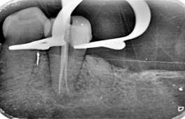 Tooth was anesthetized by inferior alveolar nerve block using a 2% solution of Lignocaine hydrochloride containing 1:80000 adrenalines.
