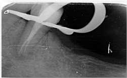 Post treatment radiograph had taken to confirm the root canal system has been densely obturated.