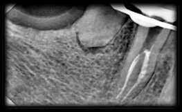 Fig-6: Pre operative OPG showing mandibular right second premolar with single canal bifurcating at middle third and showing unusual root anatomy, also widening of PDL space seen
