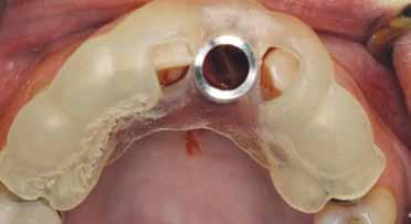 Figure 6: Using the Inclusive Tooth Replacement Solution, a custom