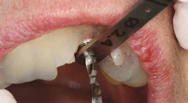 the patient s desire for a provisional restoration at the time of