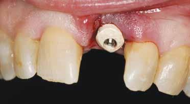 Figure 17: Due to the lower-than-requisite final torque value, the decision was made to place the custom healing abutment and seat the RPD appliance, rather than load the implant with the custom