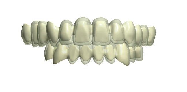 teeth providing precise contact.