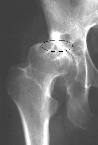 of space from the ball of the femur to the acetabulum Arthritic Hip