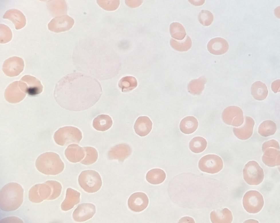 Follow-up Case: Cytochemical Stains Bone Marrow