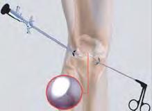 Multimedi a Health E d ucat i on a. Surgical Procedure The surgeon makes two small incisions (about ¼ of an inch) around the joint area.