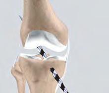 17) The arthroscope is reinserted into the knee joint and the rest of the surgery continues arthroscopically. (Refer fig.