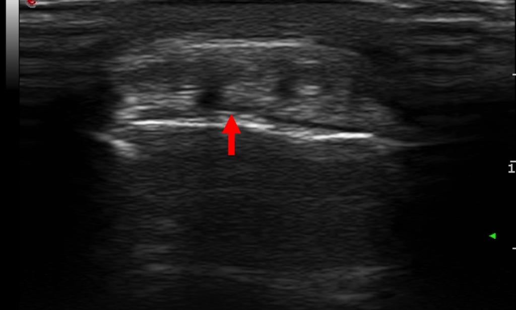 Fig. 2: Insertional tendinopathy of the triceps brachii (axial scan) that is