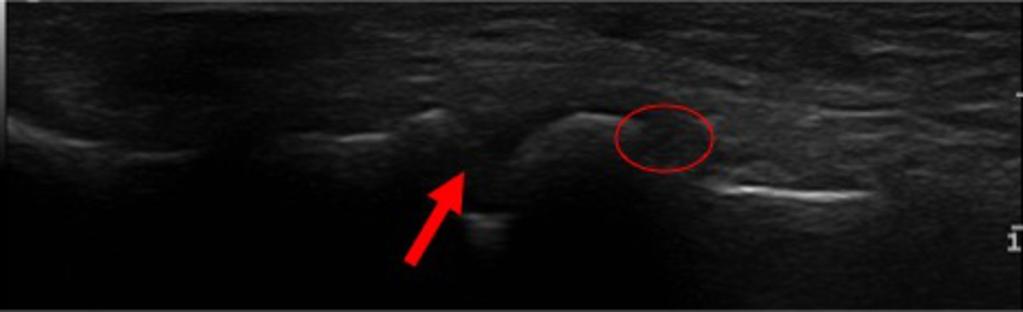 Fig. 4: Payments to load the proximal interphalangeal joint (arrow) with