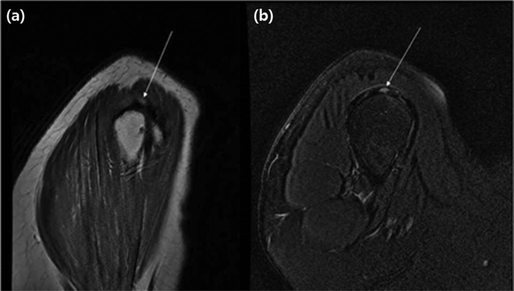 Journal of Magnetics, Vol. 22, No. 3, September 2017 523 Fig. 4. A 55-year-old woman with an articular surface partial thickness rotater cuff tear.