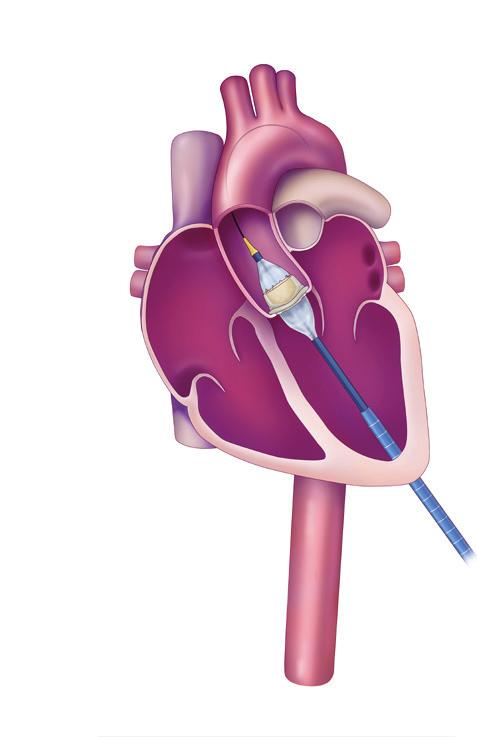 Examples of Delivery Approaches: Transcatheter Aortic Valve Replacement Transaortic (TAo) Approach
