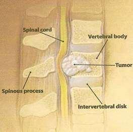 Method of spread 85%From vertebral body or pedicle 10% Through intervertebral foramina (from