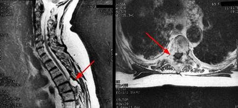 MRI of spinal cord compression in a
