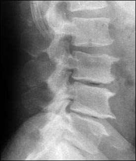 Lumbar Spine x-ray Age related degeneration Working diagnosis