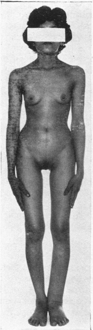 30 FiG. 3.-Case 7, aged 21. Normal development of breasts and nipples, scanty pubic hair, lymphoedema left leg. in each foot.