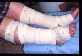 bandaging