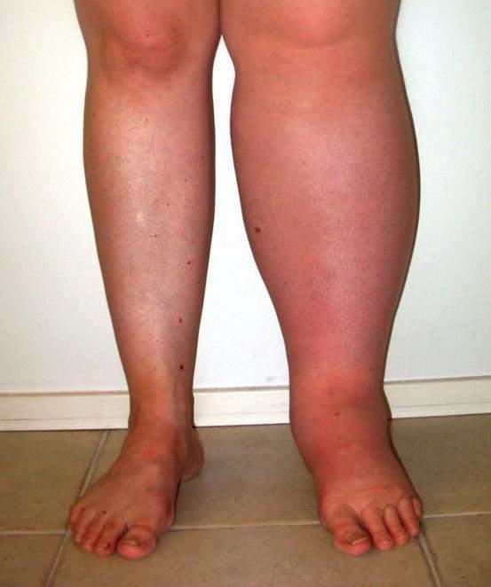 Stages of lymphoedema (ISL staging)