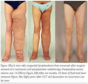 Liposuction for lymphoedema/ lipoedema Surgery to remove the fat layer.
