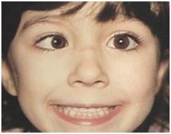 Strabismus includes common conditions like ESOTROPIA (crossing) and EXOTROPIA (drifting out or walleye ).