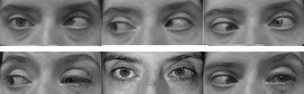 Right sixth nerve palsy with restrictive hypodeviation. Incomplete left sixth nerve paralysis. Figure 4.