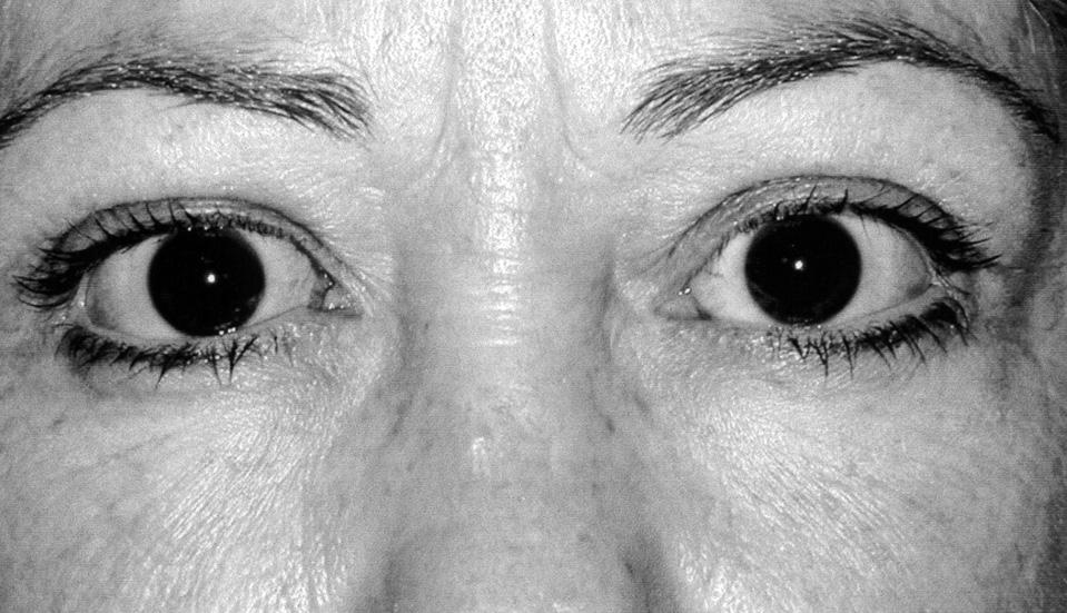 (A) Preoperative photograph of patient 9 showing upper eyelid retraction and esotropia. (B) Postoperative photograph of patient 9 after upper eyelid retraction repair and medial rectus recession.