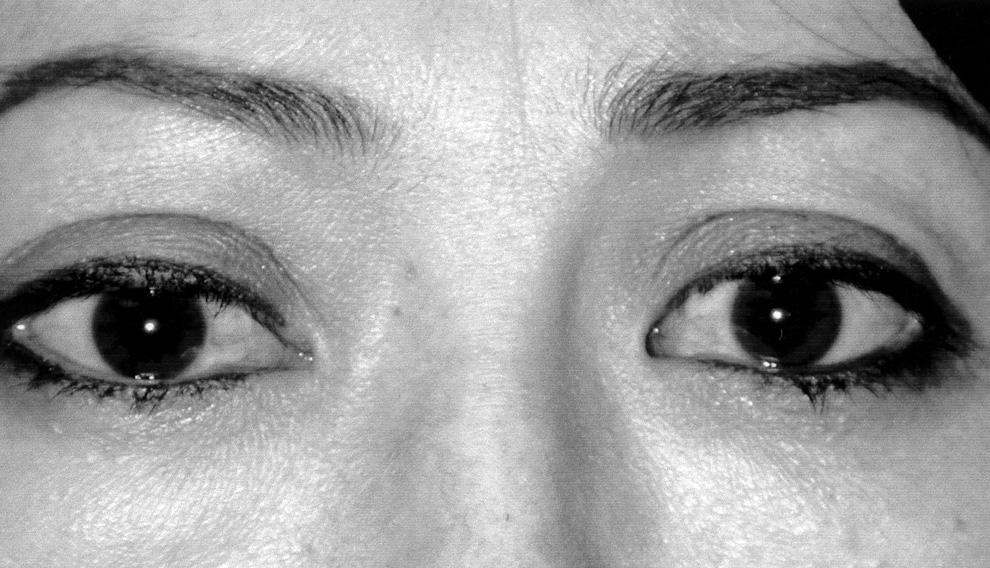 recession. The patients were observed for an average of 11 months (range: 1 to 29 months). Postoperative eyelid measurements and extraocular motility measurements were recorded.