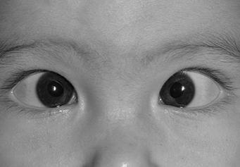 Infantile Esotropia Constant Family history Cross Fixate and Alternate Full abduction Latent nystagmus, vertical
