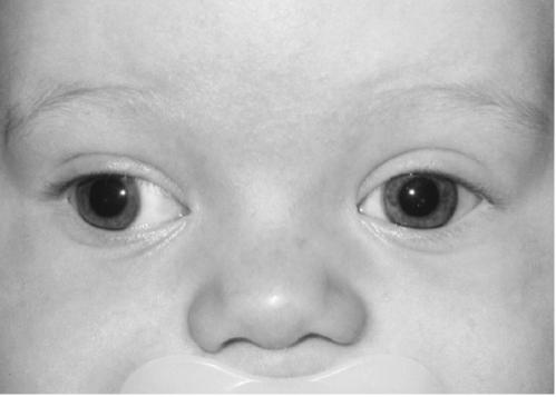 association with neurological conditions and craniofacial syndromes Alternate fixation common Association with