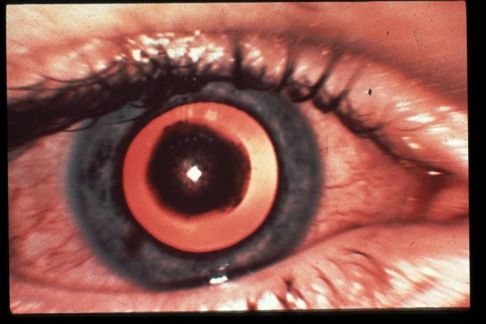 Cataract, Glaucoma, other blocking mechanisms USE